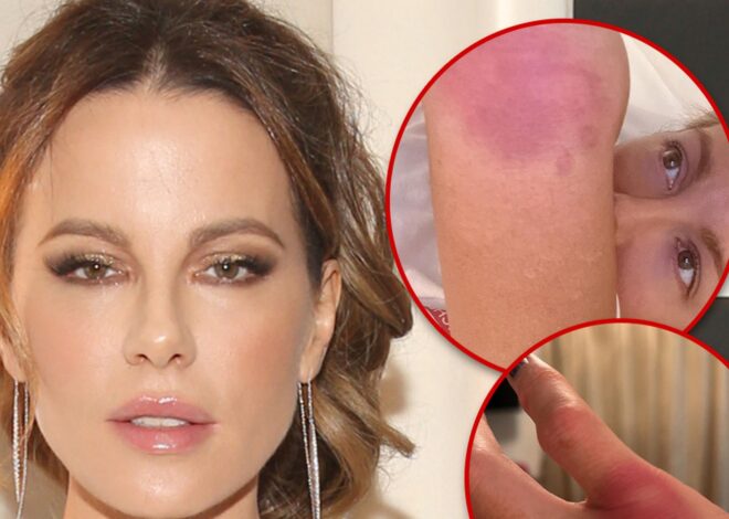 Kate Beckinsale Implies She’s Doing Own Stunts, Posts Gruesome Injury Pics