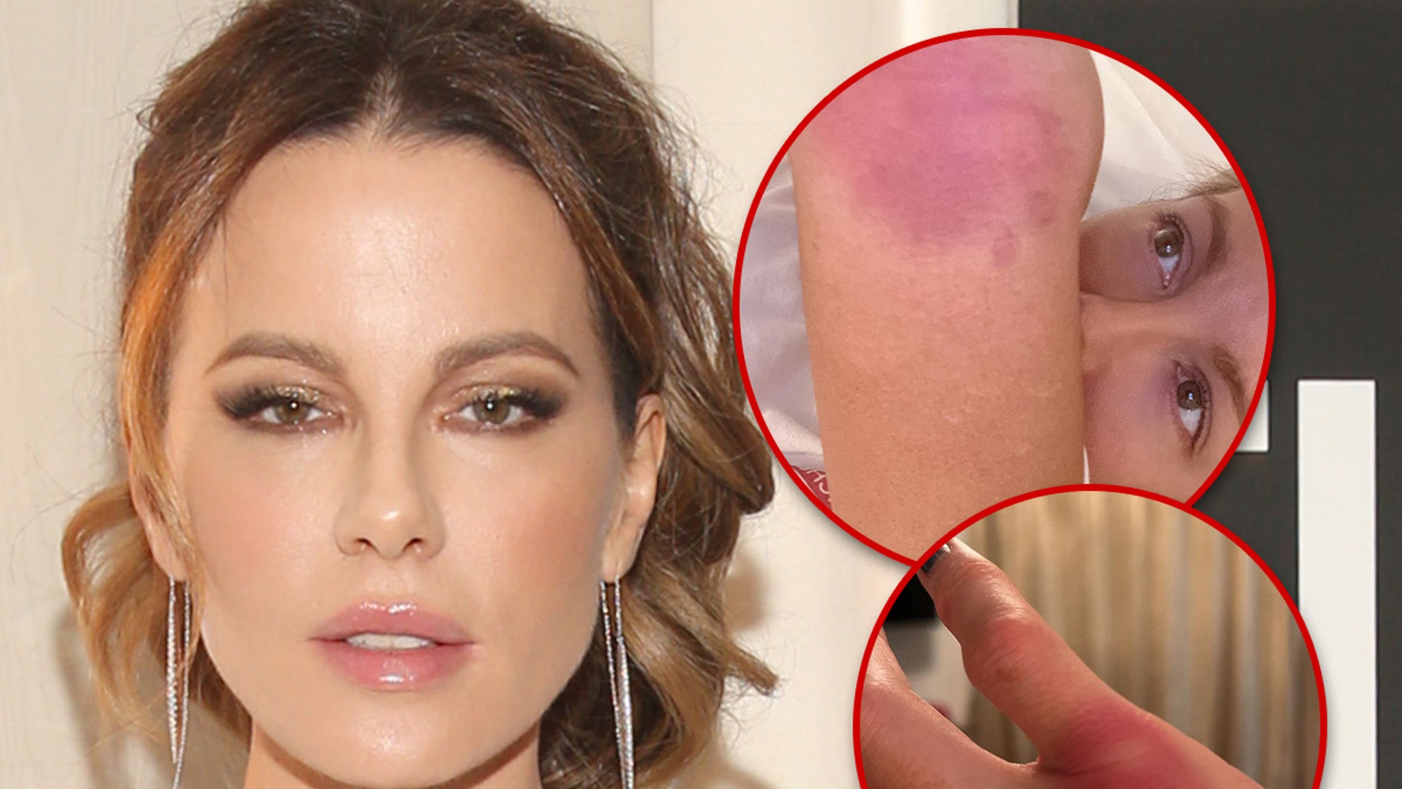 Kate Beckinsale Implies She’s Doing Own Stunts, Posts Gruesome Injury Pics