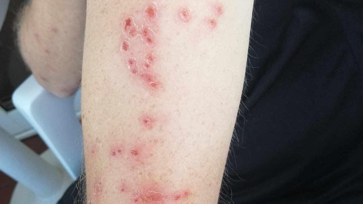 ‘Plague of bed bugs’ hit holiday hotspot and British tourists